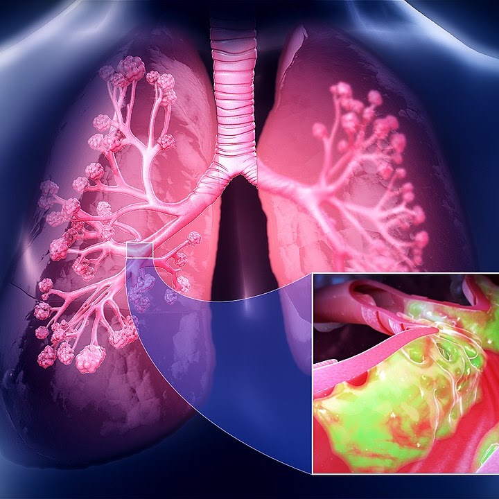 Lung Diseases